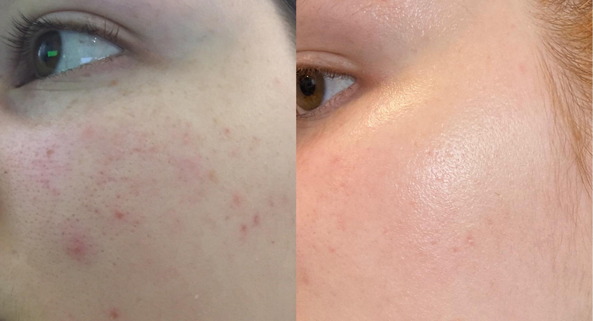 “Treating Skin With Retinoids: Tretinoin Before And After”